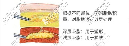 厦门薇格全身吸脂浅、深层分别处理