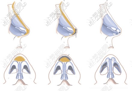 鼻假体植入图解