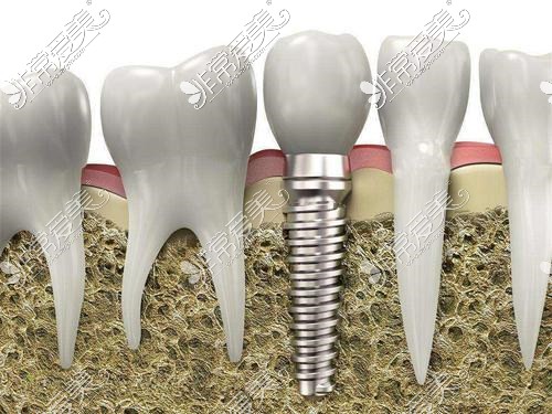 种植牙植入牙槽骨