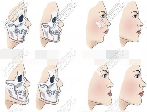 正颌手术照片