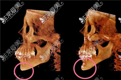 重庆星荣整形外科医院下巴整形CT