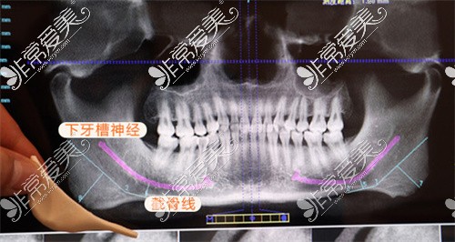 杭州连天美整形医院下颌角手术设计