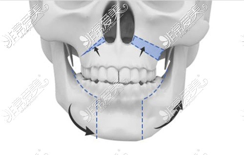 正颌手术改动区域划分