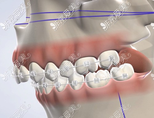正颌手术前牙齿咬合不正常