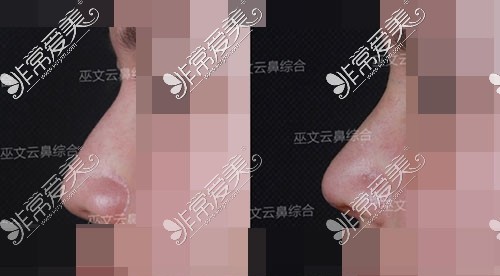 北京米扬丽格医疗美容医院巫文云鼻整形对比照片