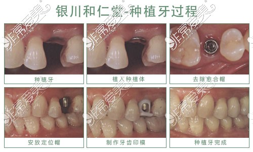 银川和仁堂口腔种植牙过程