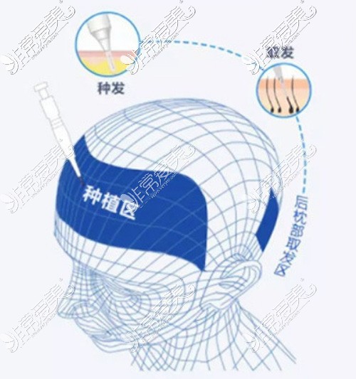 大麦微针植发过程