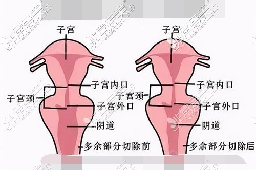 縮陰手術(shù)前后對比漫畫