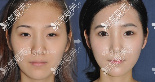 韩国4月31日整形外科双眼皮手术前后对比
