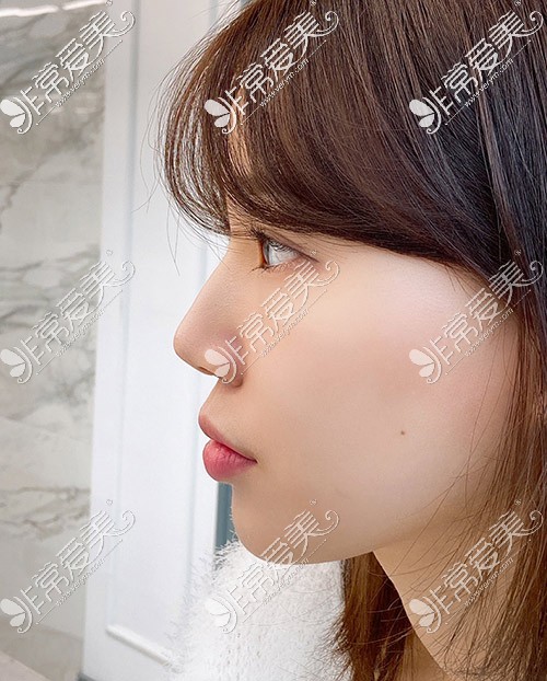 韩国优雅人整形医院肋骨鼻照片