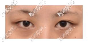 韩国icon整形医院双眼皮术前照片