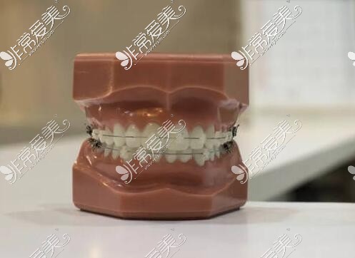 牙齿矫正材料照片展示