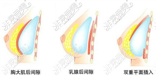 重庆五洲隆胸术