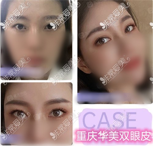 重庆华美整形眼综合手术