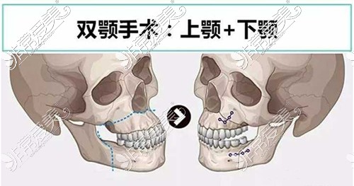 正頜手術(shù)示意圖