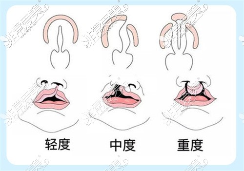 不同程度的唇腭裂