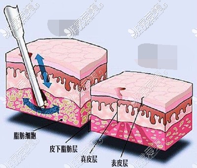 吸脂手术脂肪层对比