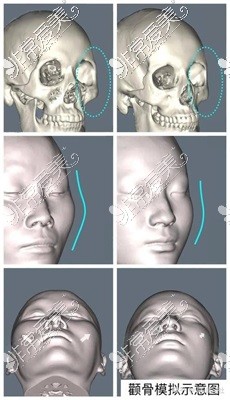 颧骨模拟示意图