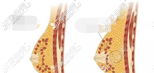 自体脂肪填充胸部前后对比