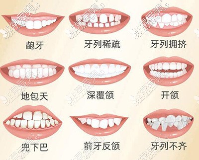 哪些牙齿需要进行正畸改善