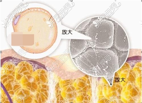 脂肪放大