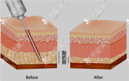 脂肪层对比