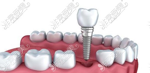 种植牙示意图