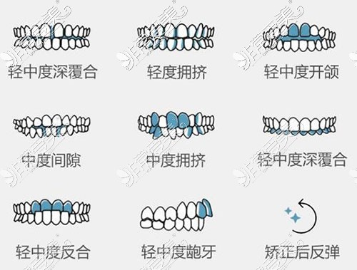 哪些牙齿需要进行改善