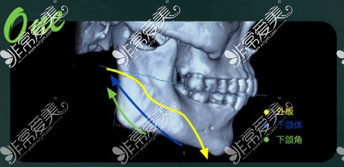杭州时光下颌角截骨术前设计