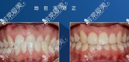 长沙牙祖口腔地包天矫正照片