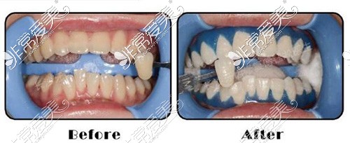 长沙牙祖口腔冷光美白照片