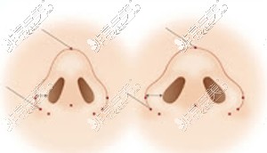 鼻翼缩小定位点