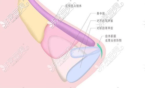 鼻整形内部支架结构