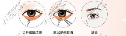 常州博仕整形内切祛眼袋手术方式