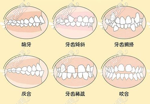 哪些牙齿需要进行正畸改善