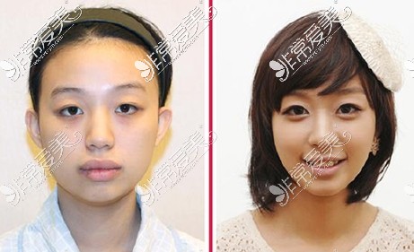 韩国菲斯莱茵整形医院双鄂突嘴手术对比照片