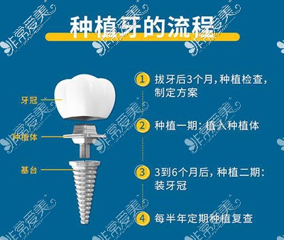 种植牙的过程是如何进行的