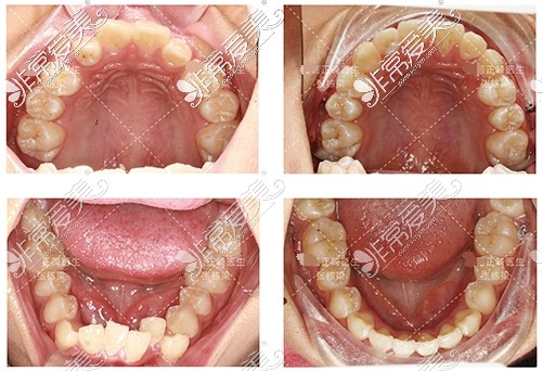 北京禾禾齒科牙齒矯正對比照片