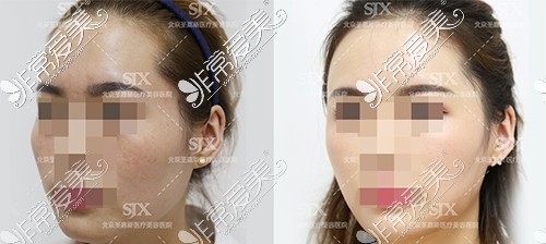 北京圣嘉新医疗美容医院面部脂肪填充对比照片