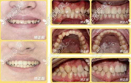 長沙牙祖口腔反頜矯正