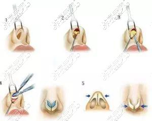 隆鼻手術(shù)過程