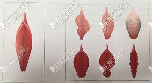 小阴唇的理想形状和其他不同形态