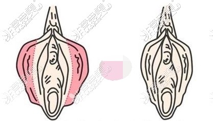 小阴唇整形前后对比漫画