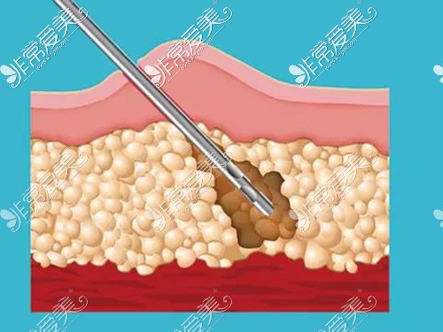 吸脂手術(shù)示意圖