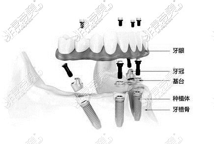 all-on-4種植技術(shù)卡通圖
