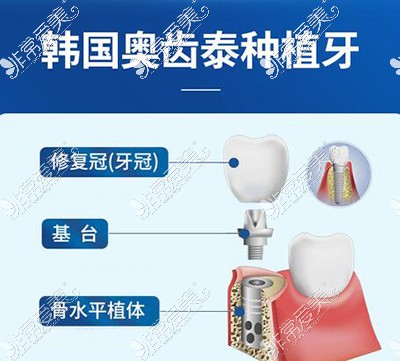 种植牙卡通材料照片