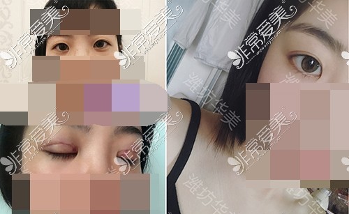 潍坊华美医疗美容医院双眼皮手术对比照片