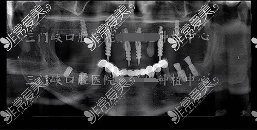 三门峡口腔医院种植牙拍片
