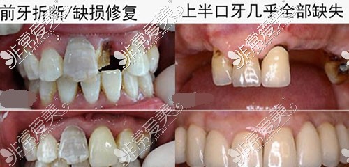 惠州致美口腔医院牙齿缺失示意图