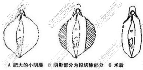 陰唇縮小術(shù)示意圖